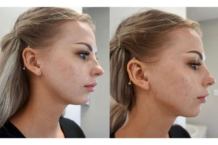 Face Fillers 101: A Guide to Natural-Looking Results